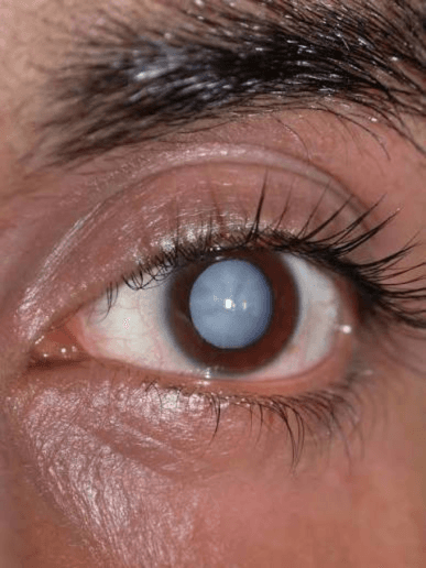 Eye Health